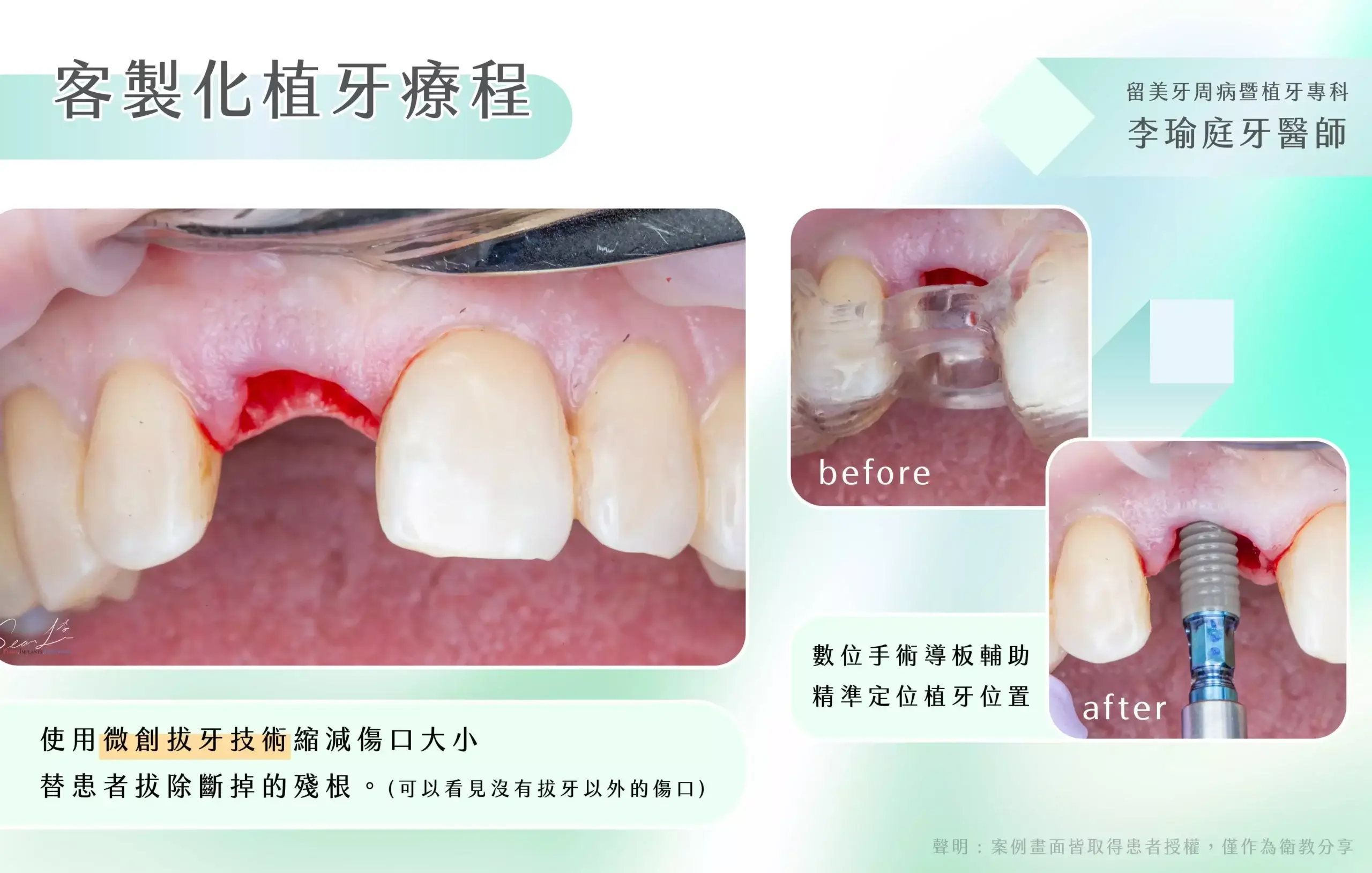 即拔即種客製化植牙療程