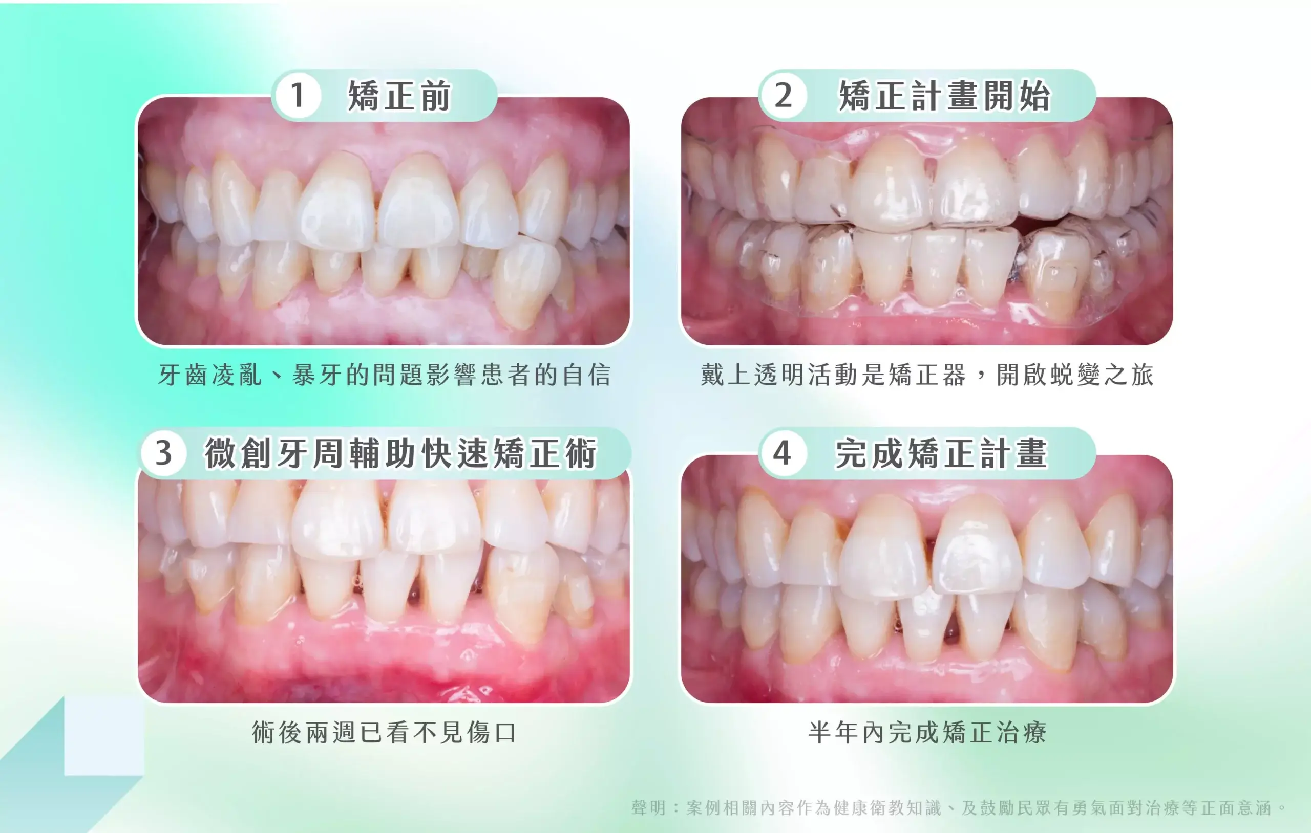 牙周輔助快速矯正流程介紹