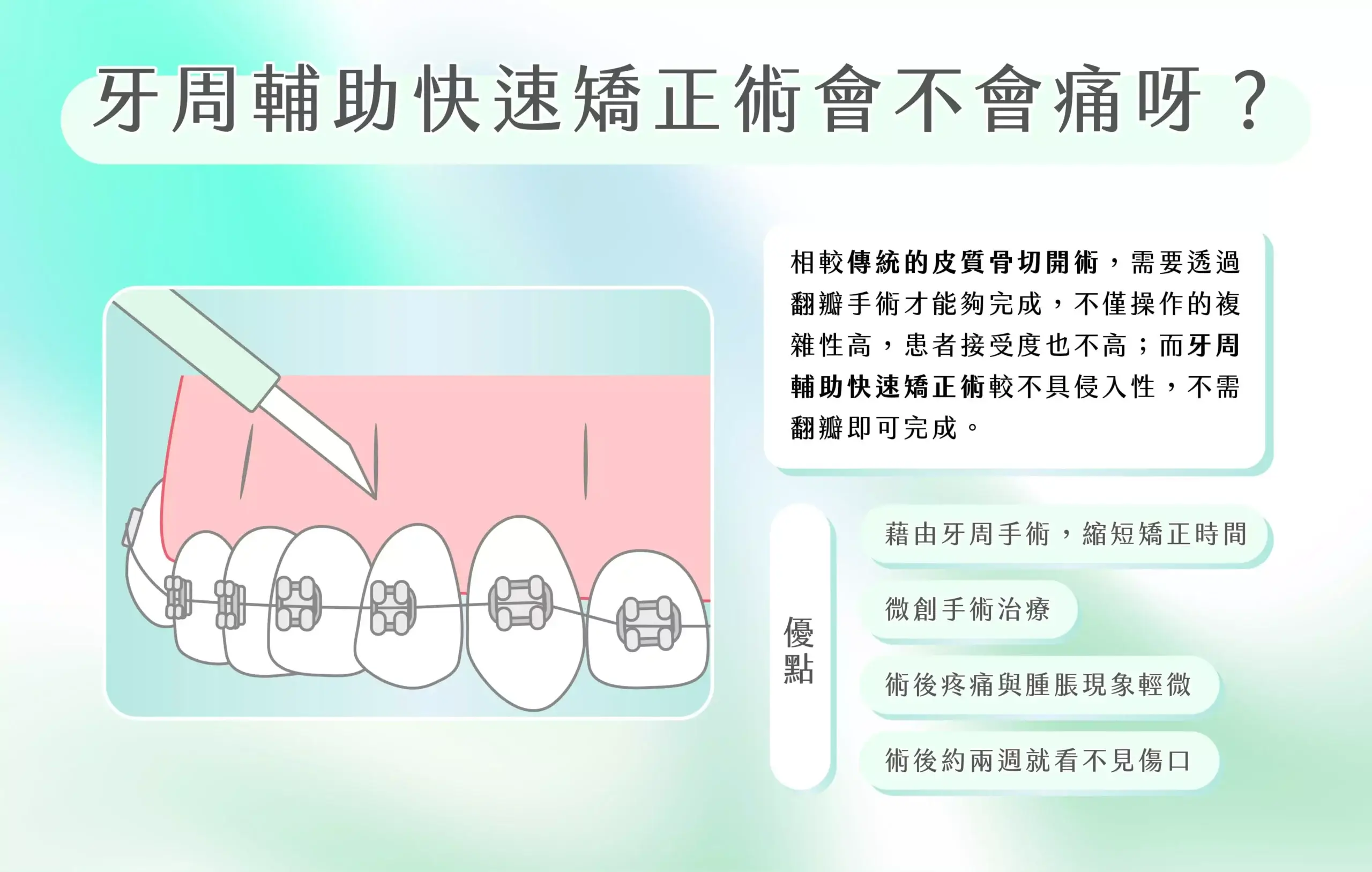 牙周輔助快速矯正會不會痛