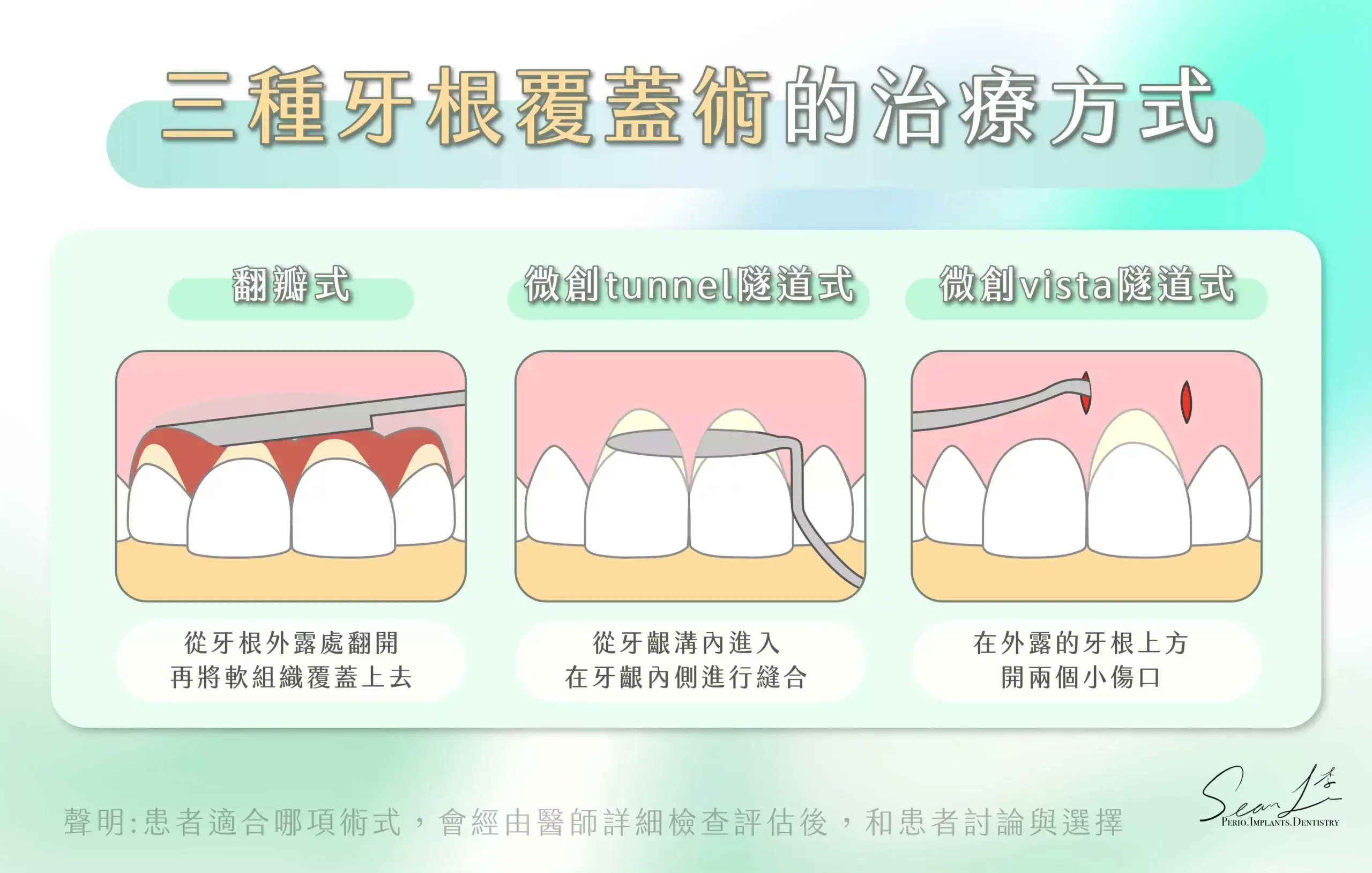 三種牙根覆蓋術的治療方式