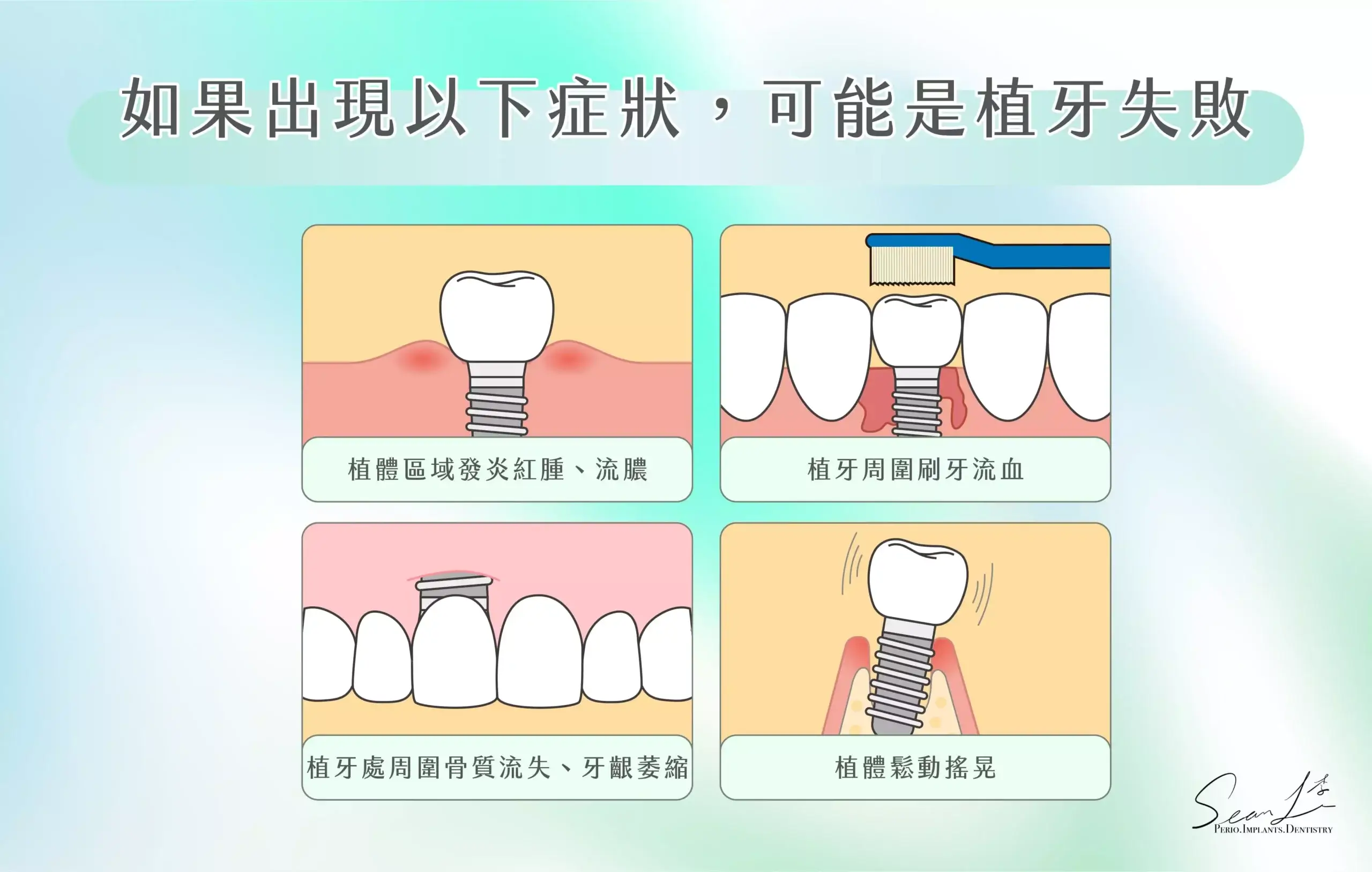 四個常見的植牙失敗後遺症：1. 植體區域發炎紅腫、流膿 2. 植牙周圍刷牙流血 3. 植牙處周圍骨質流失、牙齦萎縮 4. 植體鬆動搖晃