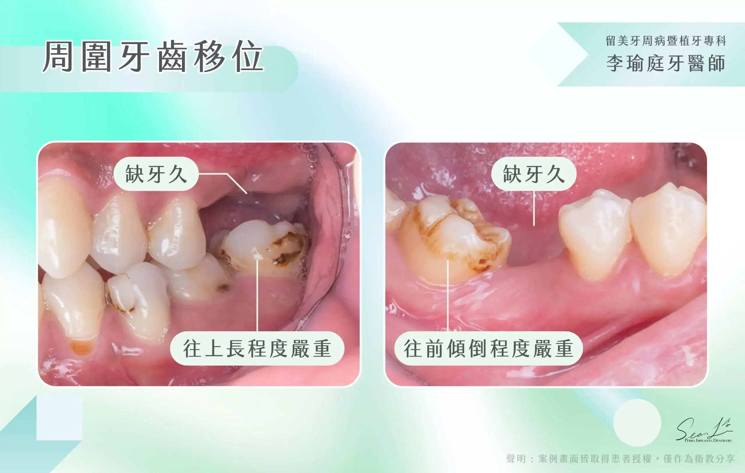 當齒槽骨上缺失了一顆牙齒出現空隙，鄰近的牙齒會因為失去支撐而開始移動，傾向移動填補這個空間，久而久之，造成更多牙齒因移位而受損，因小失大。牙齒移位的情況還可能導致顳顎關節出現問題，張口就感到疼痛，嚴重還會、產生頭痛和頸部疼痛。