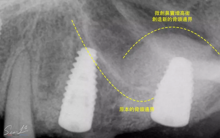 微創鼻竇增高術案例二